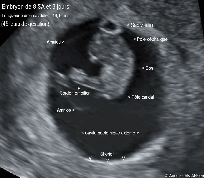 Embryon âgé de 45 jours de gestation (8 SA + 3 jours) - مضغة بعمر 45 يوماً أو 8 أسابيع 3 و  أيام من اِنقطاع الطمث