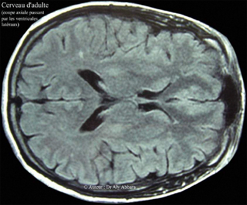 Cerveau d'adulte - IRM - Coupe axiale - ventricules latéraux