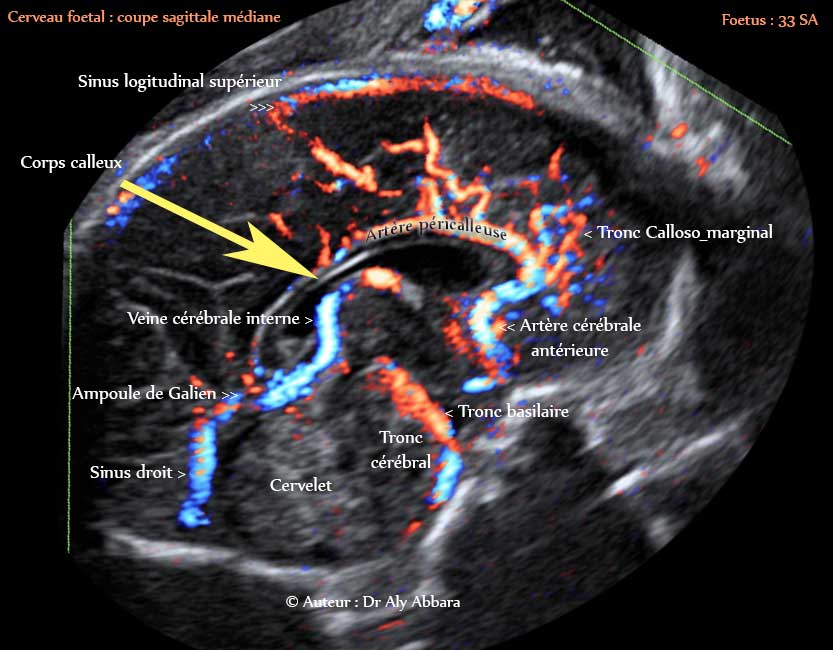 Coupe sagittale médiane du cerveau foetale - vaisseaux sanguins et les structures anatomiques identifiable à 33 SA - échocardiographie