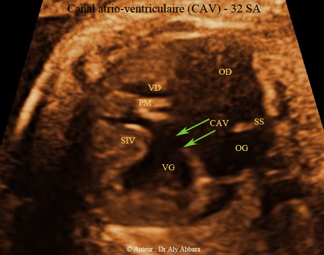 Canal atrio-ventriculaire complet - CAV - 32 SA - trisomie 21 - القناة الأذينية البطينية في شكلها التام