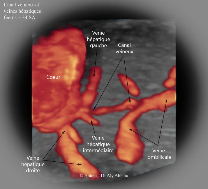 Les rapports anatomiques entre le canal veineux (ductus veineux) et les trois veines hépatiques