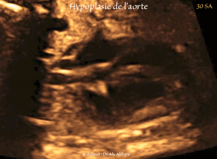 Hernie-diaphragmatique mise en évidence à 13 SA et 14 jours dans un contexe polymalformatif