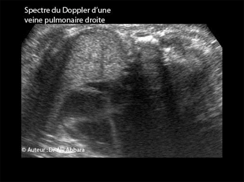 Veine pulmonaire - Spectre Doppler (Dynamic-Flow) 