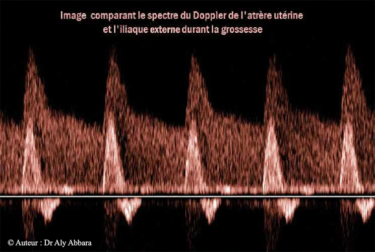 Image échographique comparant le spectre Doppler de l'artère utérine à celui de l'artère iliaque externe