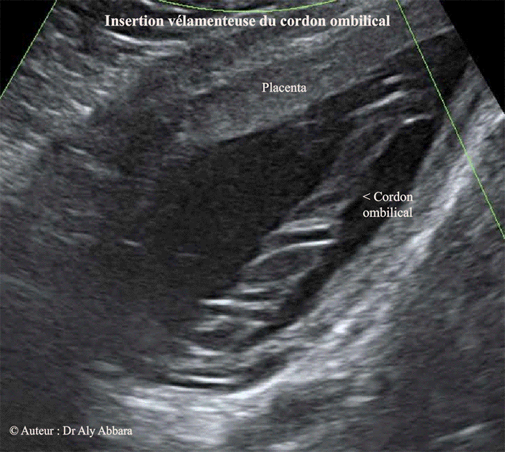 Cordon ombilical -Insertion vélamenteuse du cordon côté placenta