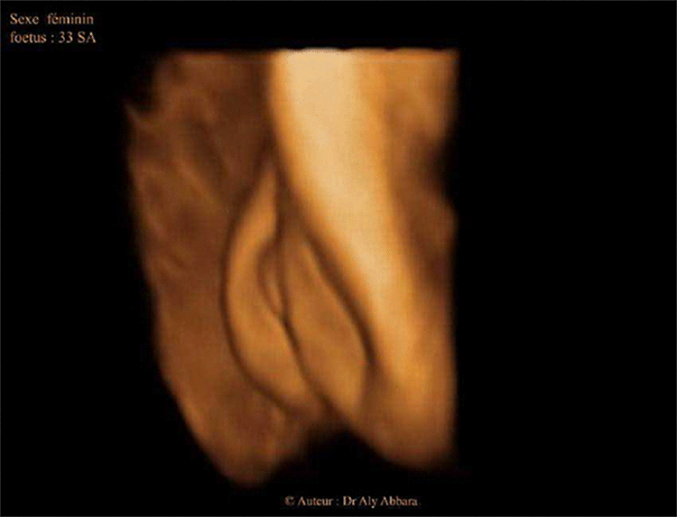 Organes génitaux externes chez un foetus du sexe féminin ; 33 SA