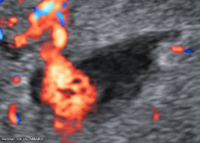 Caverne placentaire : aspect échographique avec Doppler couleur - tourbillons sanguins