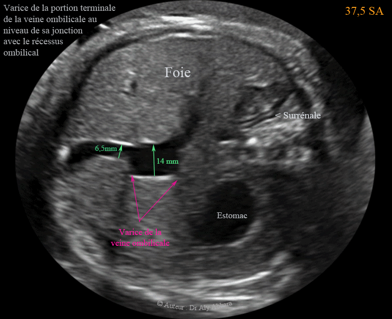 Varice proximale de la veine ombilicale intra-abdominale  - دوالي الوريد السري داخل بطن الجنين