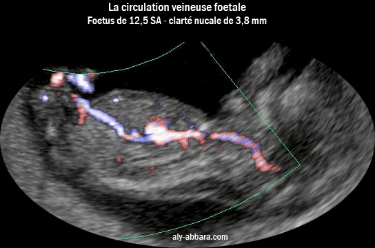 Image analysant la circulation foetale veineuse à 12,5 SA