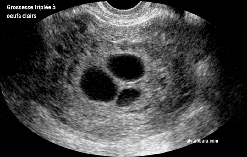 Oeuf clair triple - Trois sacs gestationnels sans structures embryonnaires