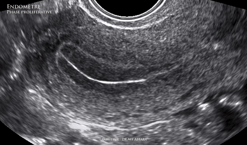 Utérus - la contractilité utérine et l'aspect échographique  de l'endomètre en fin de la phase proliférative (pré-ovulatoire)