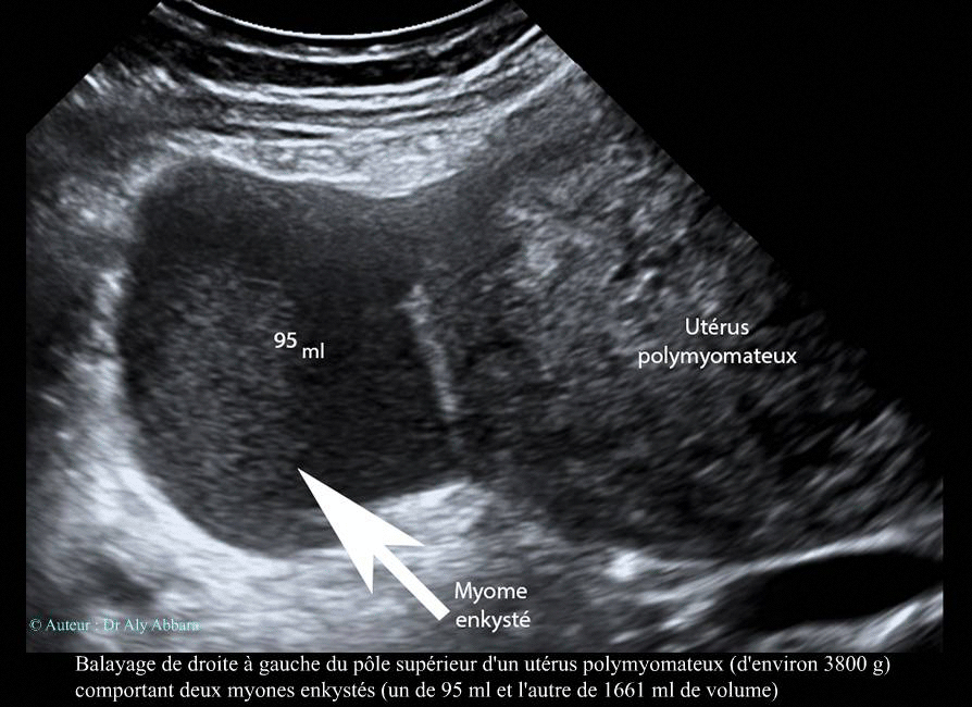 Kystes sous séreux utérins par dégénérescence kystique de fibromes