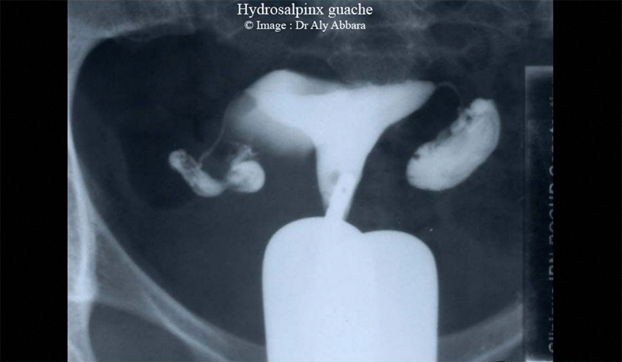 Hystérosalpingographie (HSG) - Hydrosalpinx gauche - S2
