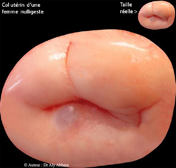 Col utérin (cervix) chez une femme nullipare - Image clinique