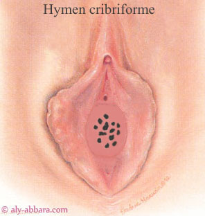 16_hymen_cribriforme_2.jpg