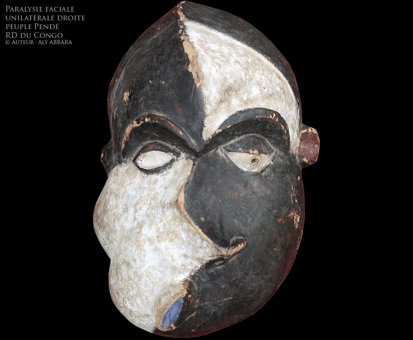 Masque polychrome représentant une face déformée par une paralysie faciale périphérique droite - Sculpture du peuple Pendé - RD du Congo