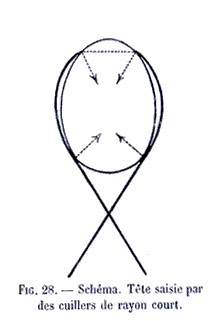Forceps : t&ecirc;te saisie par des cuilliers de rayon court