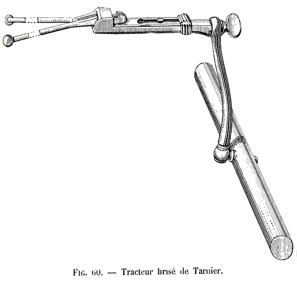 Tracteur bris&eacute; du forceps classique de Tarnier