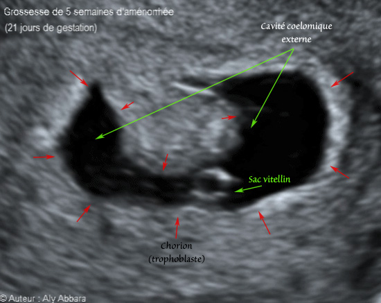 Sac gestationnel de 20 à 21 jours de gestation (5 SA) - كيس حملي بعمر 20 إلى 21 يوماً من الحمل أو 5 أسابيع من اِنقطاع الطمث