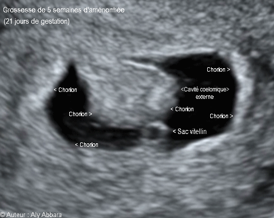 Sac gestationnel de 20 à 21 jours de gestation (5 SA) - كيس حملي بعمر 20 إلى 21 يوماً من الحمل أو 5 أسابيع من اِنقطاع الطمث