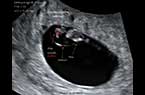 Embryon de 7 SA et 2 jours (LCC = 11.47 mm) - Les premiers mouvements embryonnaires - Vidéo pour YouTtube