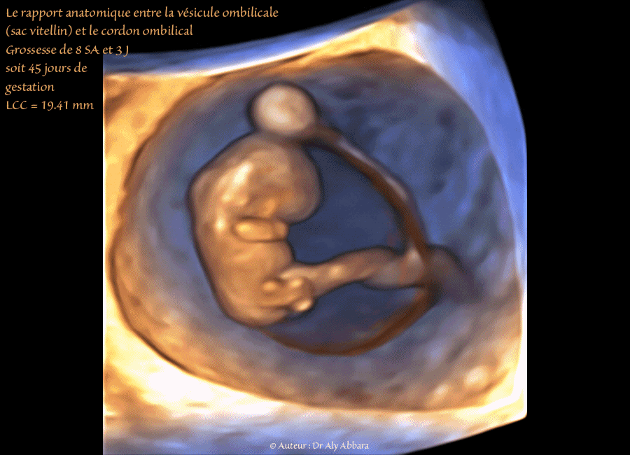 Embryon âgé de 45 jours de gestation (8 SA + 3 jours) - Vésicule ombilicale - مضغة بعمر 45 يوماً  - الحويصل السري