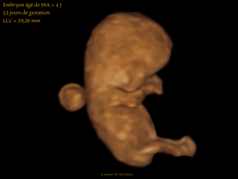 Embryon âgé de 53 jours de gestation (9 SA + 4 jours) - Composantes anatomiques - مضغة بعمر 53 يوماً - العناصر التشريحية الجنينية