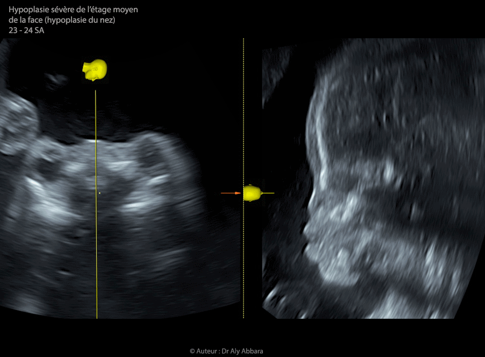 Kyste cytotrophoblastique intra-parenchymateux