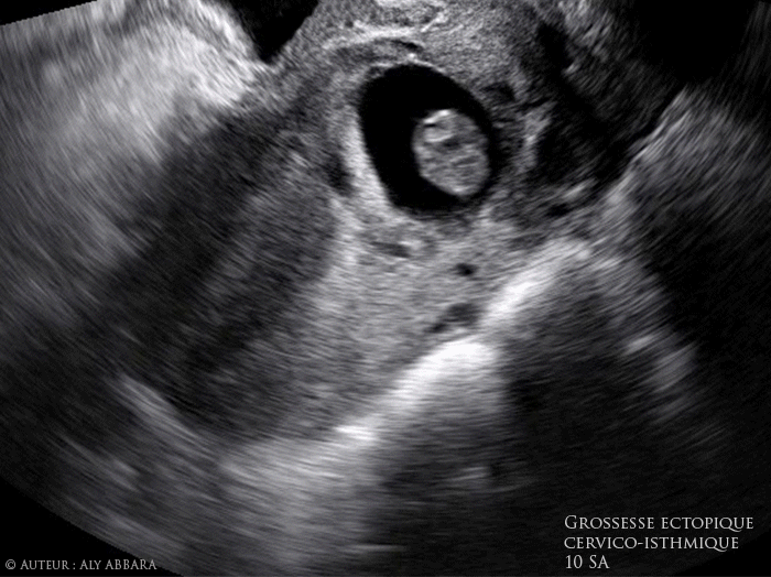 Grossesse évolutive extra-utérine cervico-isthmique intra-murale antérieure (au niveau de l'ancienne cicatrice de césarienne) évolutive de 10 SA