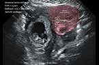 Grossesse extra-utérine tubaire distale droite, évolutive, de 9 SA et 2 Jours d'âge - Activité cardiaque et mouvements embryonnaires sont présents - coupe transverse de l'utérus