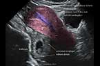 Grossesse extra-utérine tubaire distale droite, évolutive, de 9 SA et 2 Jours d'âge - Activité cardiaque et mouvements embryonnaires sont présents - coupe sagittale médiane sur l'utérus