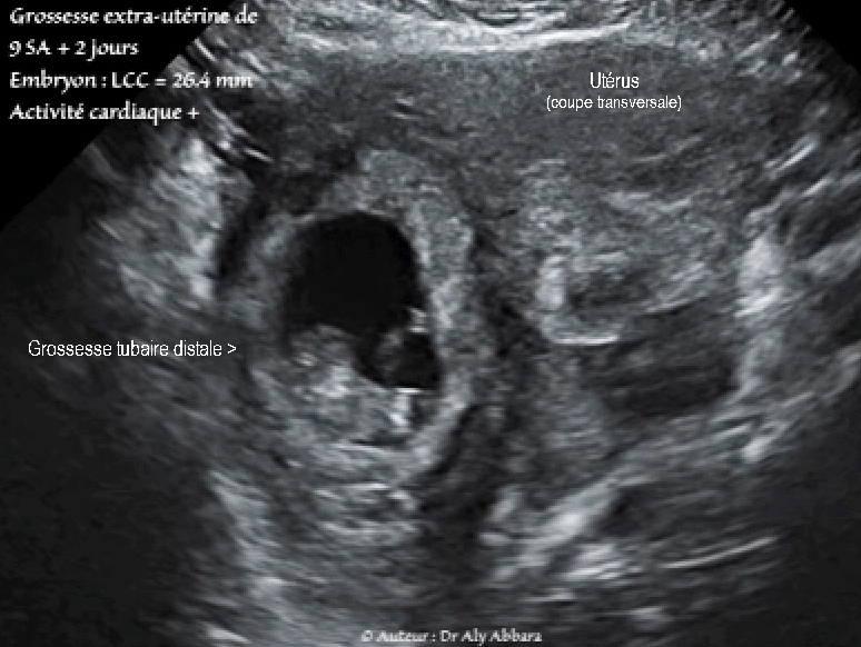 Grossesse extra-utérine tubaire distale évolutive âgée de 9 SA et 2 jours : activité cardiaque positive ; mouvements actifs positifs ; longueur craniocaudale égale à 26,4 mm - coupe transverse de l'utérus