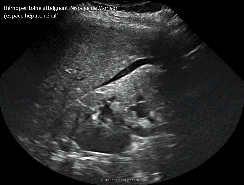 Hémopéritoine atteignant l'espace de Morison