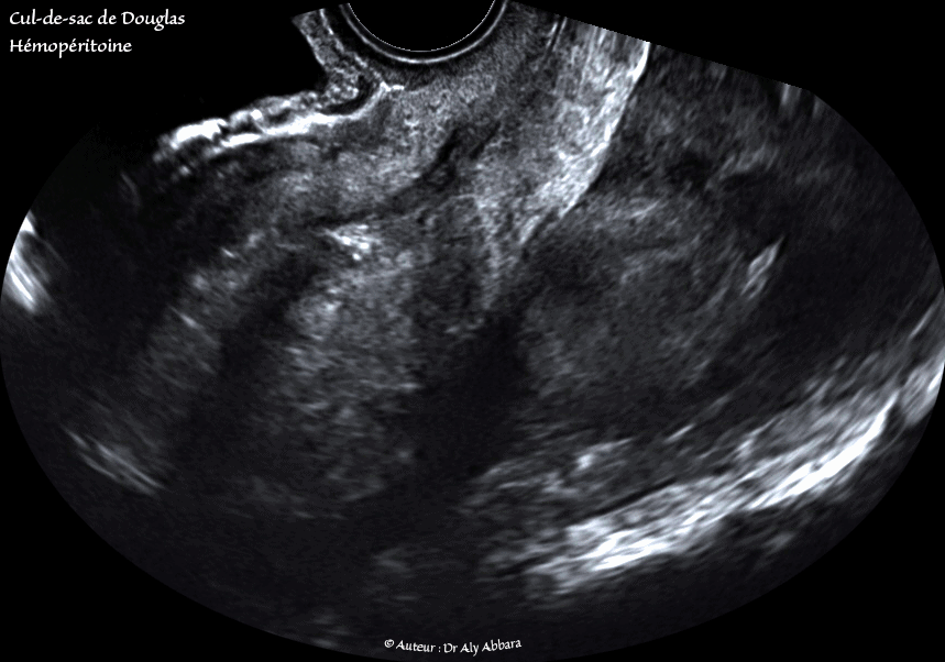 Hémopéritoine inondant le petit pelvis