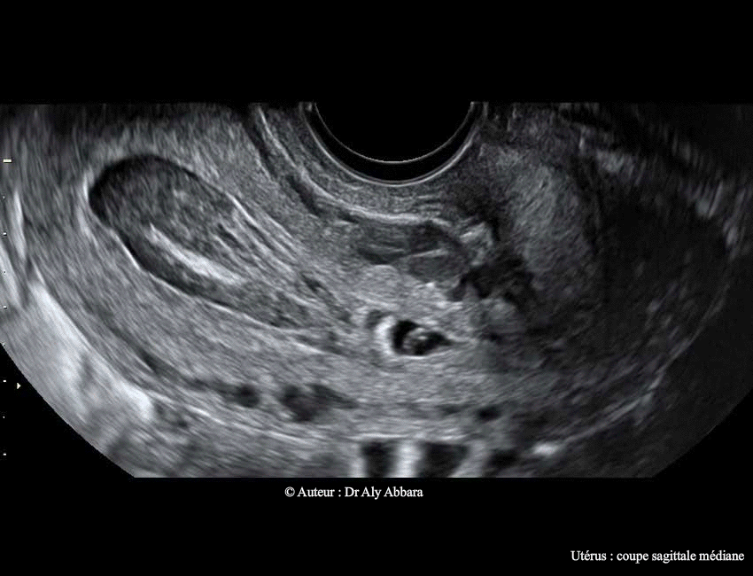 geu d'implantation isthmique utérine