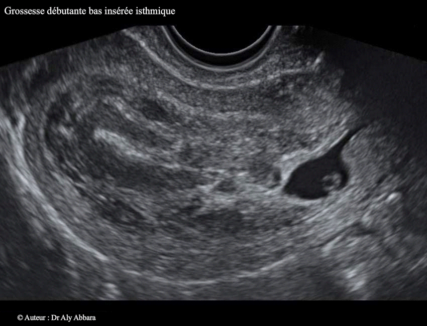 GEU itmique utérine - J4