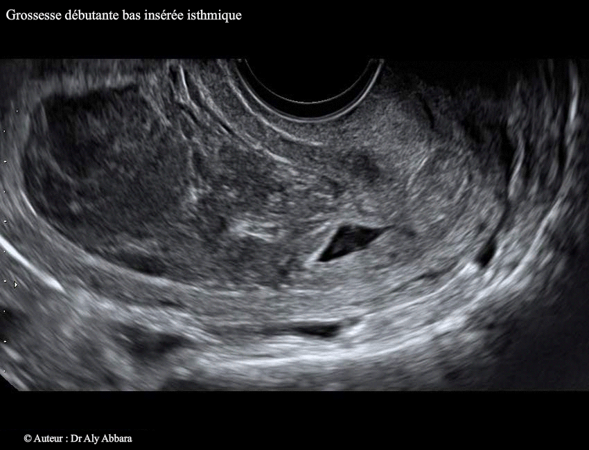 GEU isthmique utérine -  J6