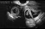 Grossesse triple évolutive hétérotopique composée d'une grossesse gémellaire intra-utérine et une grossesse mono-embryonnaire extra-utérine tubaire droite