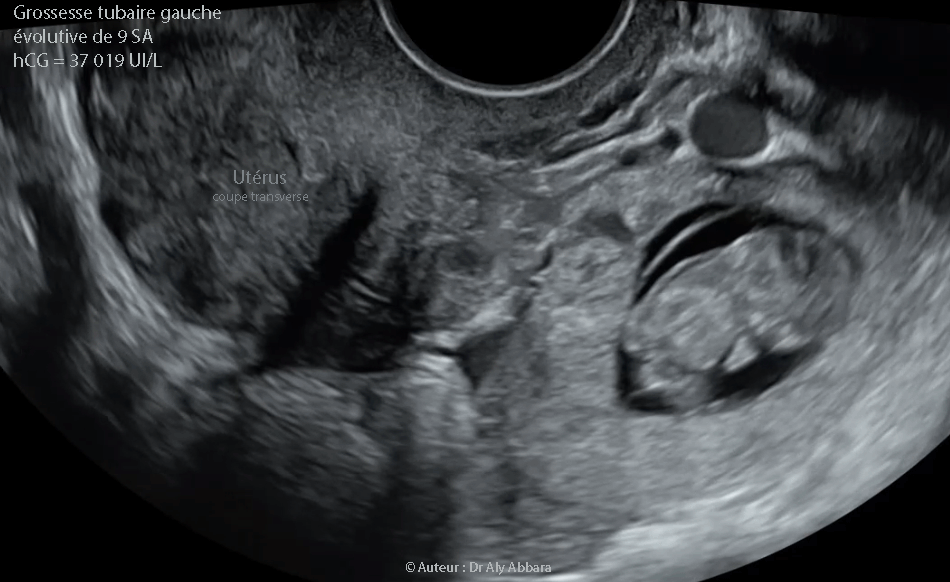 Grossesse extra-utérine tubaire distale évolutive âgée de 9 SA et 2 jours : activité cardiaque positive ; mouvements actifs positifs ; longueur craniocaudale égale à 26,4 mm - coupe transverse de l'utérus