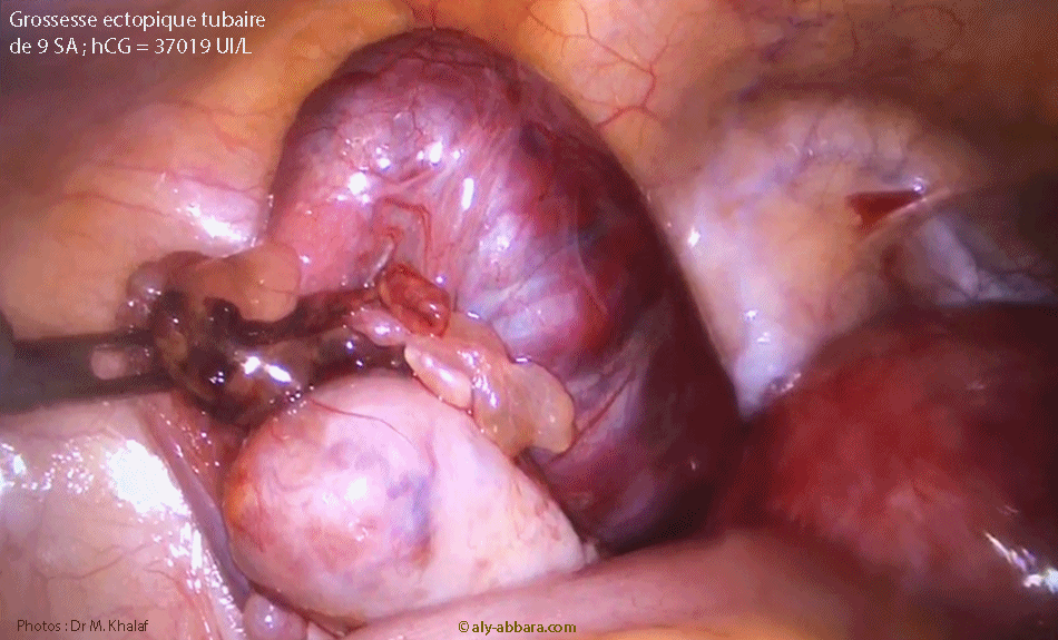 Grossesse extra-utérine tubaire gauche évolutive de 9 SA et 1 J