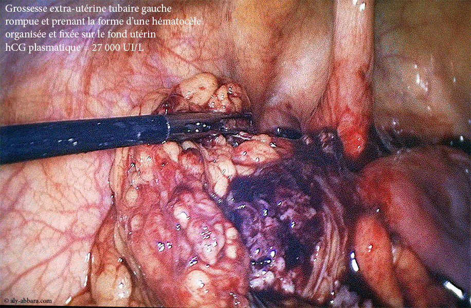 Grossesse extra-utérine tubaire gauche évolutive de 9 SA et 1 J