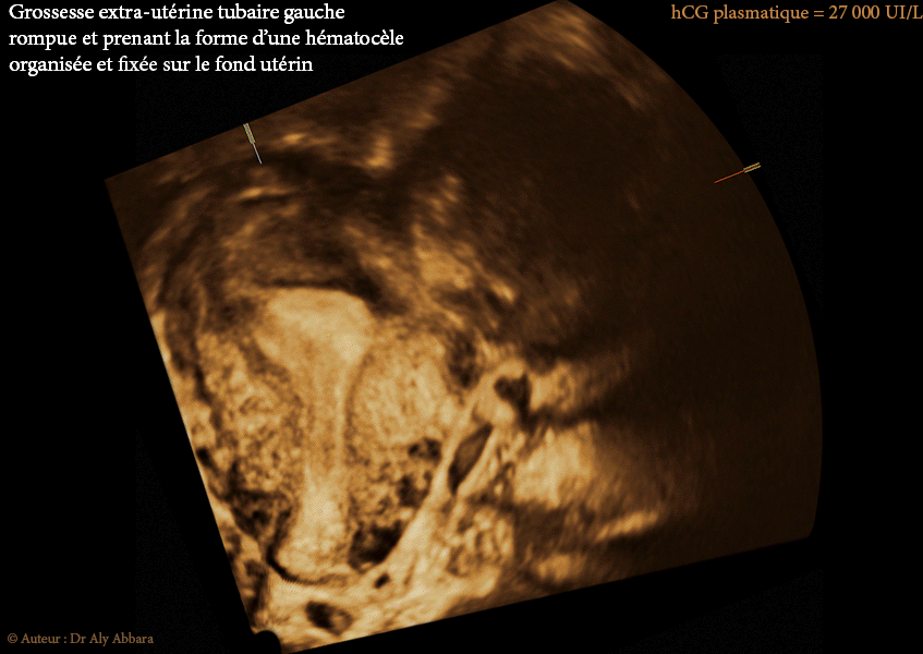 Grossesse extra-utérine tubaire distale évolutive âgée de 9 SA et 2 jours : activité cardiaque positive ; mouvements actifs positifs ; longueur craniocaudale égale à 26,4 mm - coupe transverse de l'utérus