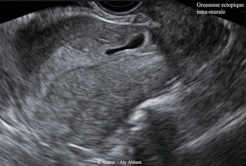 Grossesse intra-murale-Uc-A