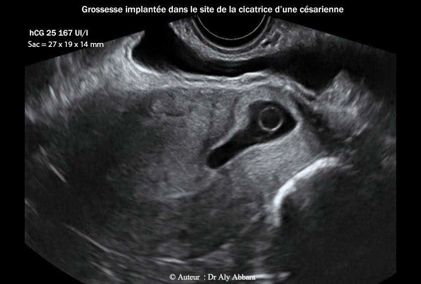 Grossesse ectopique intra-murale sur utérus cicatriciel