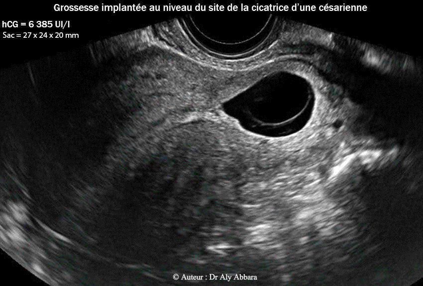 Grossesse intra-murale ectopique sur utérus cicatriciel