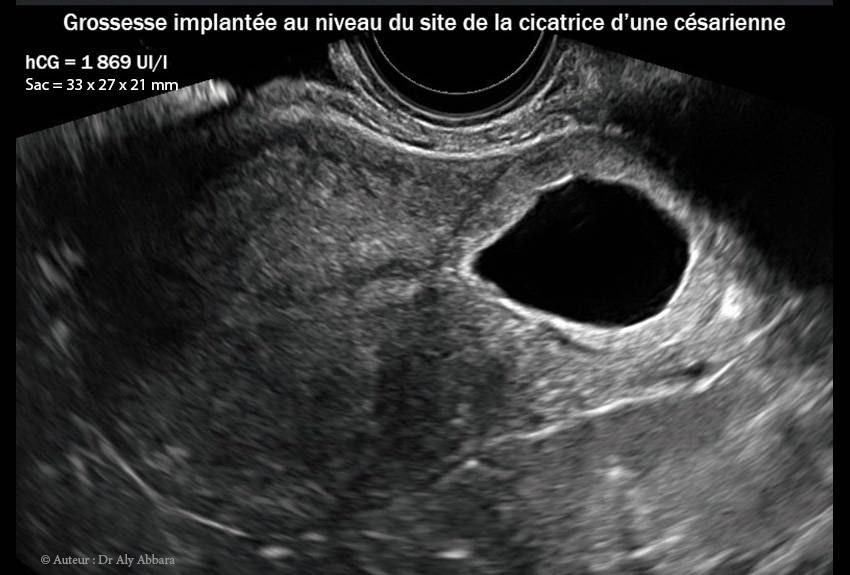 Grossesse ectopique intra-murale sur utérus cicatriciel