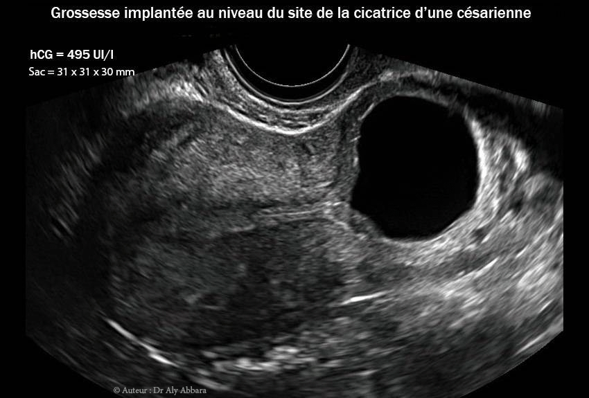 Grossesse-extra-utérine intramurale sur utérus cicatriciel