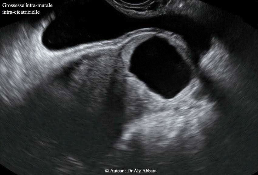 Grossesse ectopique intramurale sur utérus cicatriciel