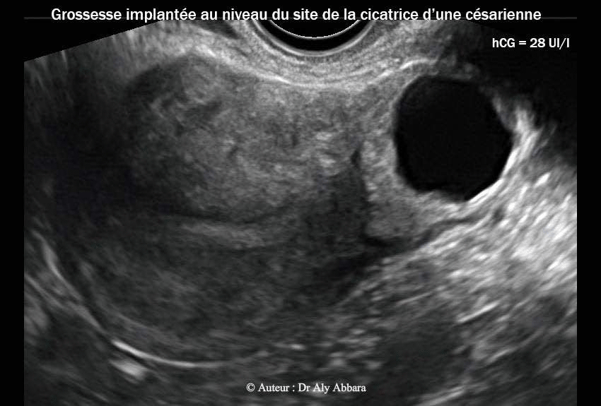Grossesse extra-utérine intramurale sur utérus cicatriciel