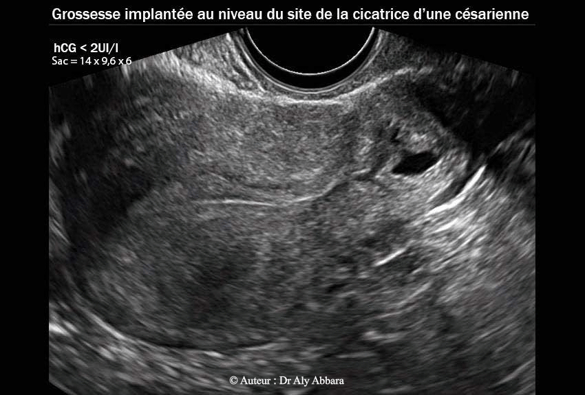 Grossesse ectopique intramurale sur utérus cicatriciel - 50 jours après le traitement par méthotrexate